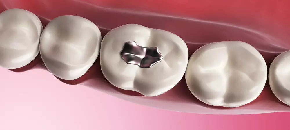  آمالگام برای ترمیم دندان