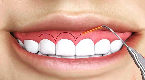  افزایش تاج دندان