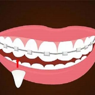 مشکلات و درمان دندان نیش