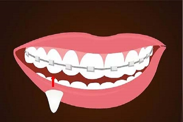 مشکلات و درمان دندان نیش