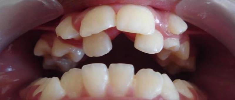 شلوغی دندان