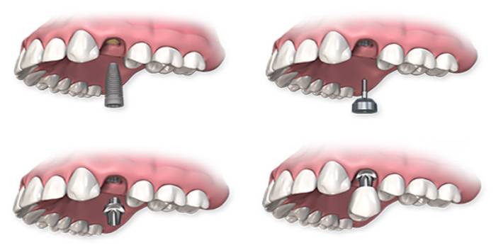 مراحل ایمپلنت دندان