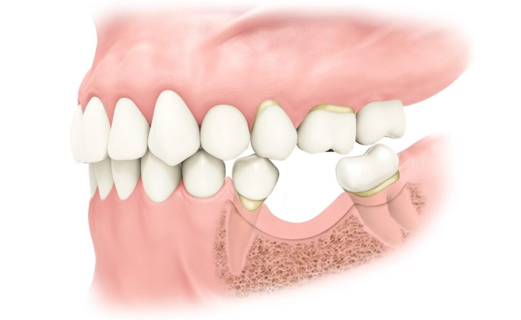 قیمت پیوند استخوان برای ایمپلنت دندان چقدر است؟