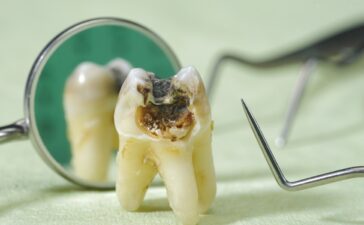 پالپکتومی دندان