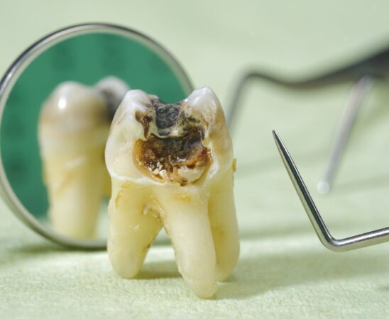پالپکتومی دندان