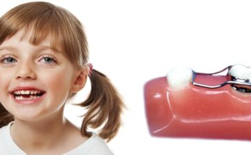 فضا نگهدارنده دندان کودکان