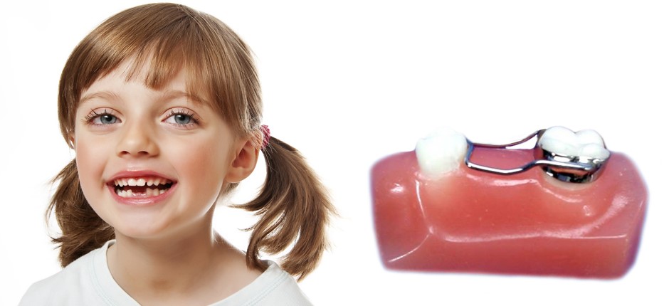 فضا نگهدارنده دندان کودکان