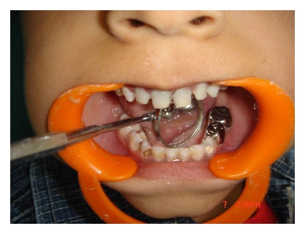 نحوه انجام پالپکتومی دندان کودکان