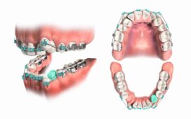 ارتودنسی دندان اضافی