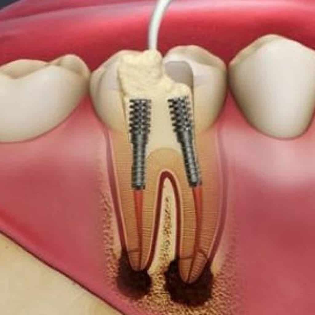 پین دندانپزشکی