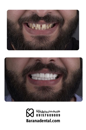  کامپوزیت دندان مشهد
