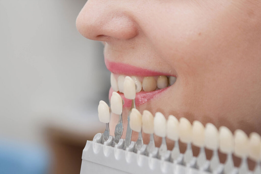 درمان زیبایی دندان با استفاده از کامپوزیت