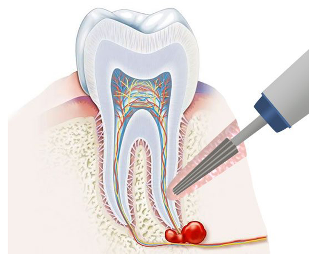 مراحل درمان عصب کشی دندان به شرح زیر است