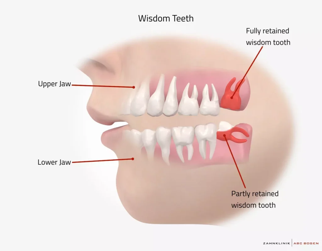 دلایل به وجود آمدن درد دندان عصب کشی شده