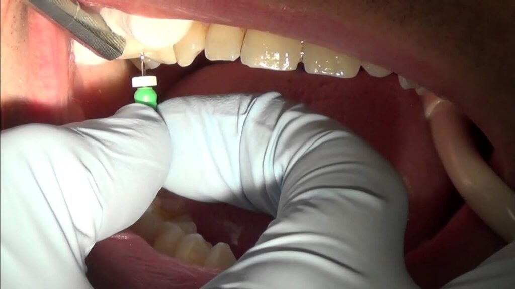 روش انجام عصب‌کشی مجدد دندان