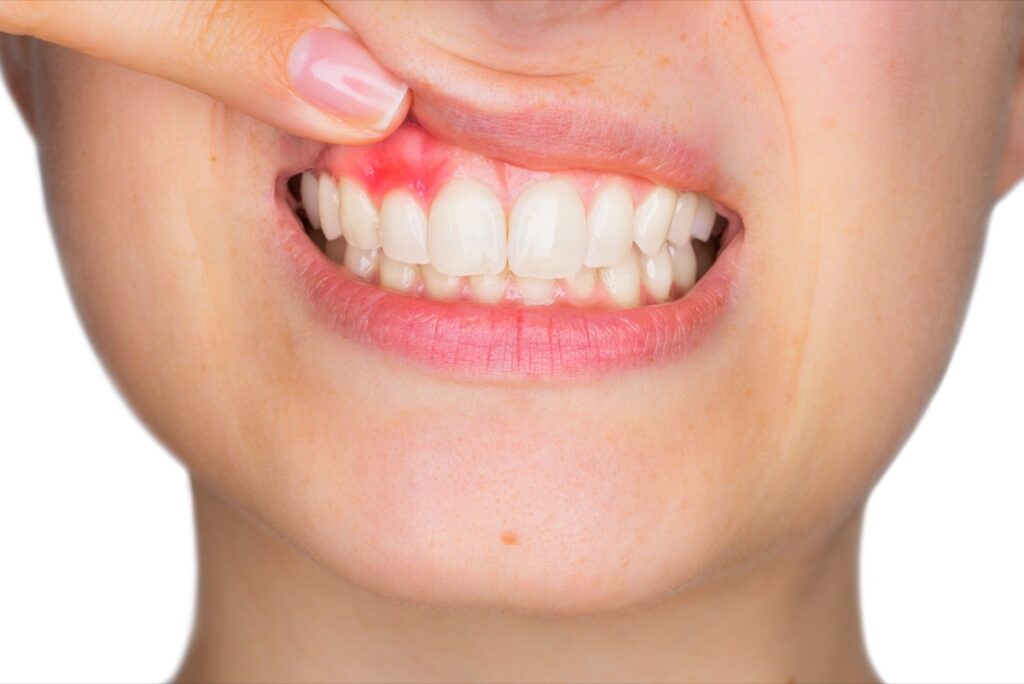 آنتی بیوتیک طبیعی برای عفونت دندان