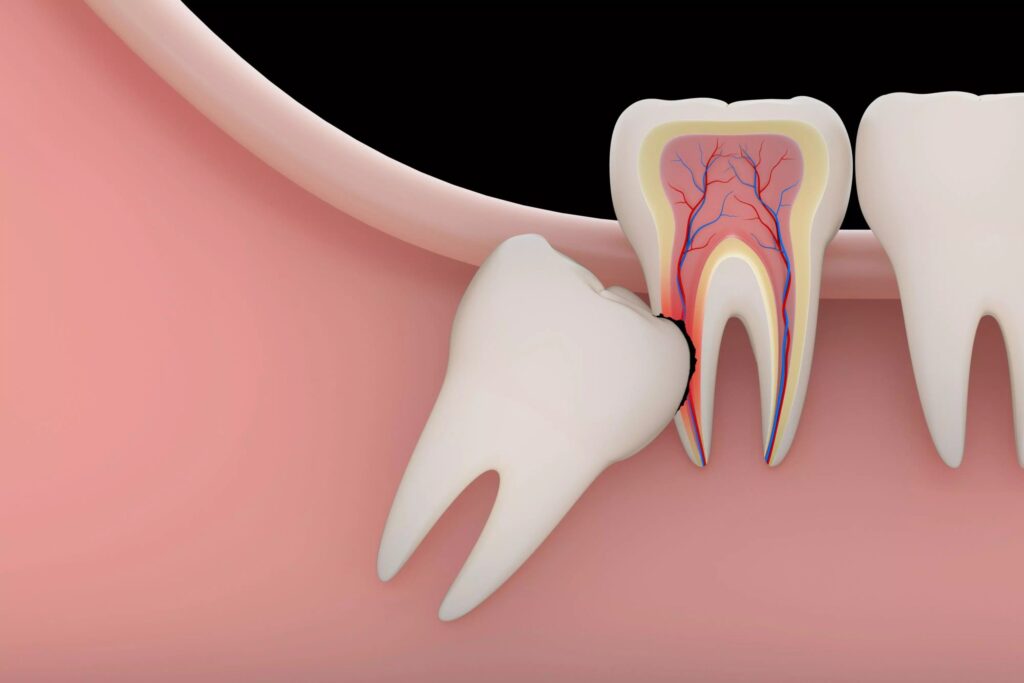 عوارض باز شدن سینوس حین کشیدن دندان و راه‌های درمان آن
