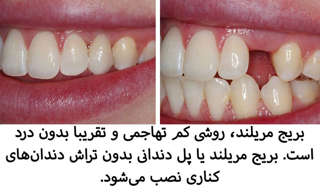 عکس قبل و بعد از بریج بدون تراش دندان