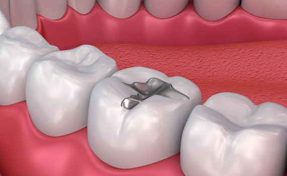 آمالگام دندانی چیست؟ + بررسی کاربرد مواد آمالگام دندانی - مجله آموزشی سلامت دندان