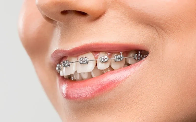 ارتودنسی ثابت فلزی