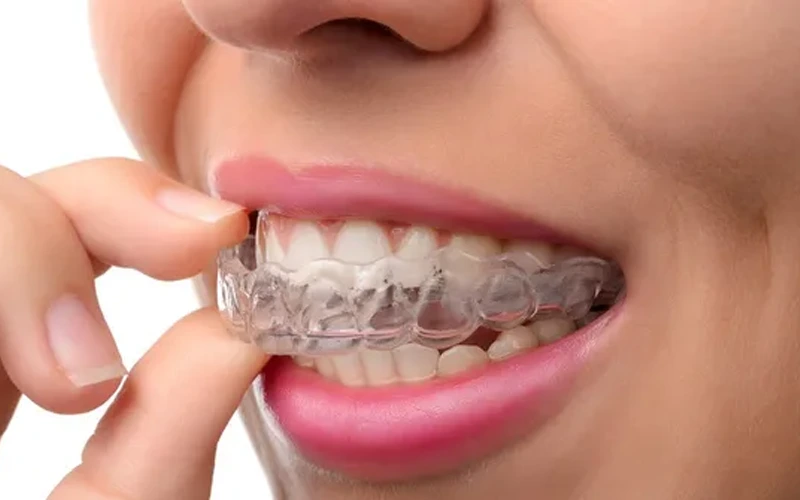 ارتودنسی شفاف با الاینرهای نامرئی