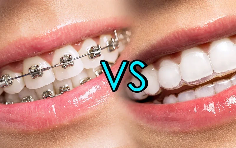 مقایسه ارتودنسی فلزی و نامرئی