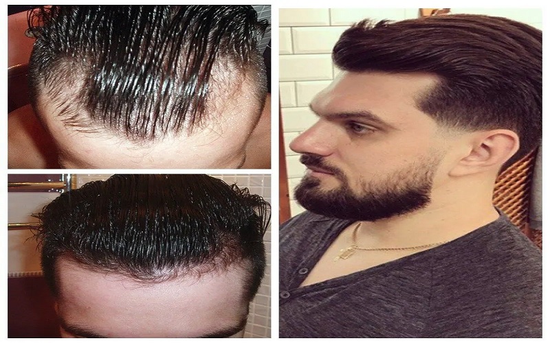 روش‌های جایگزین برای کم‌پشتی شدید مو