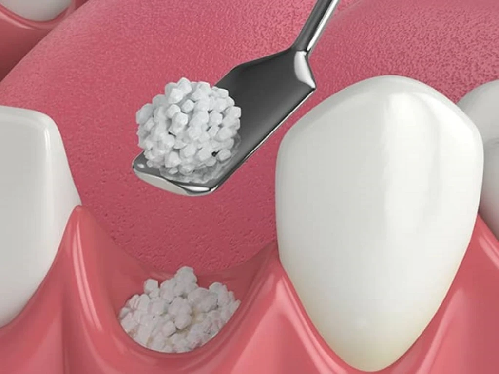 پودر استخوان دندانپزشکی