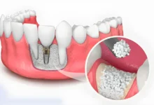 پودر استخوان دندانپزشکی؛ راهنمای جامع انتخاب، کاربرد و مراقبت