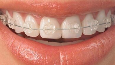 ارتودنسی تا چند سالگی جواب میده