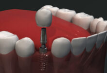 انواع ایمپلنت دندان