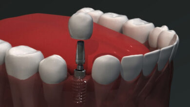 انواع ایمپلنت دندان
