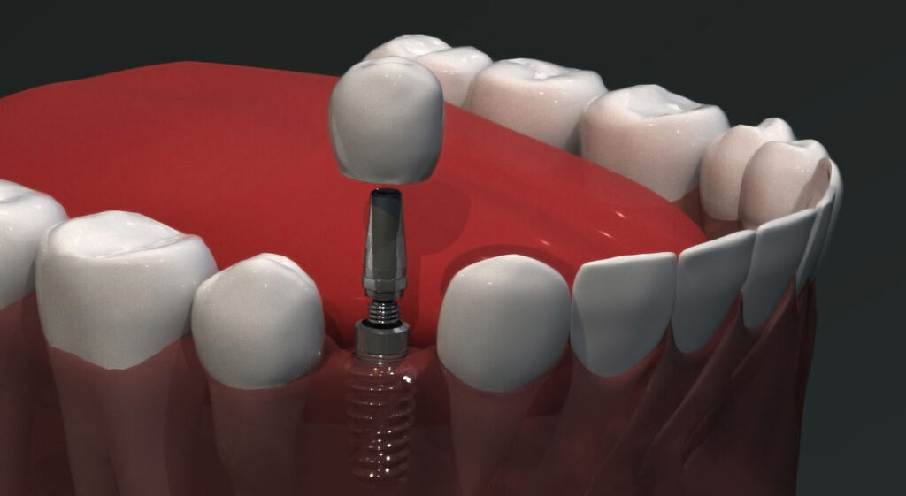 انواع ایمپلنت دندان