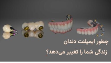 چطور ایمپلنت دندان زندگی شما را تغییر میدهد؟