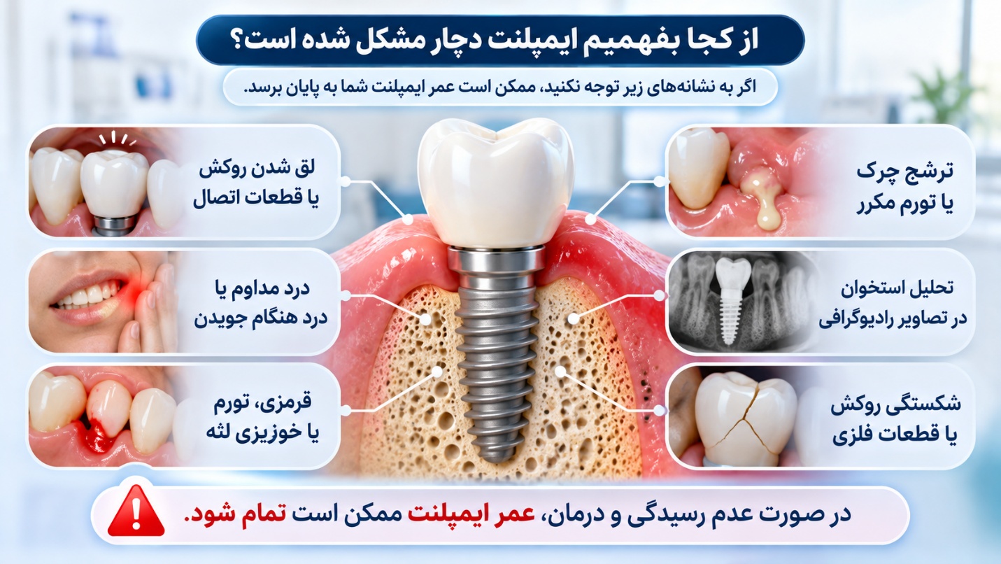 علائم خراب شدن ایمپلنت و احتمال پایان عمر آن